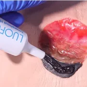Amorphous Hydrogel Dressing