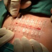 Bi-Fix Surgical Incision Closure Set